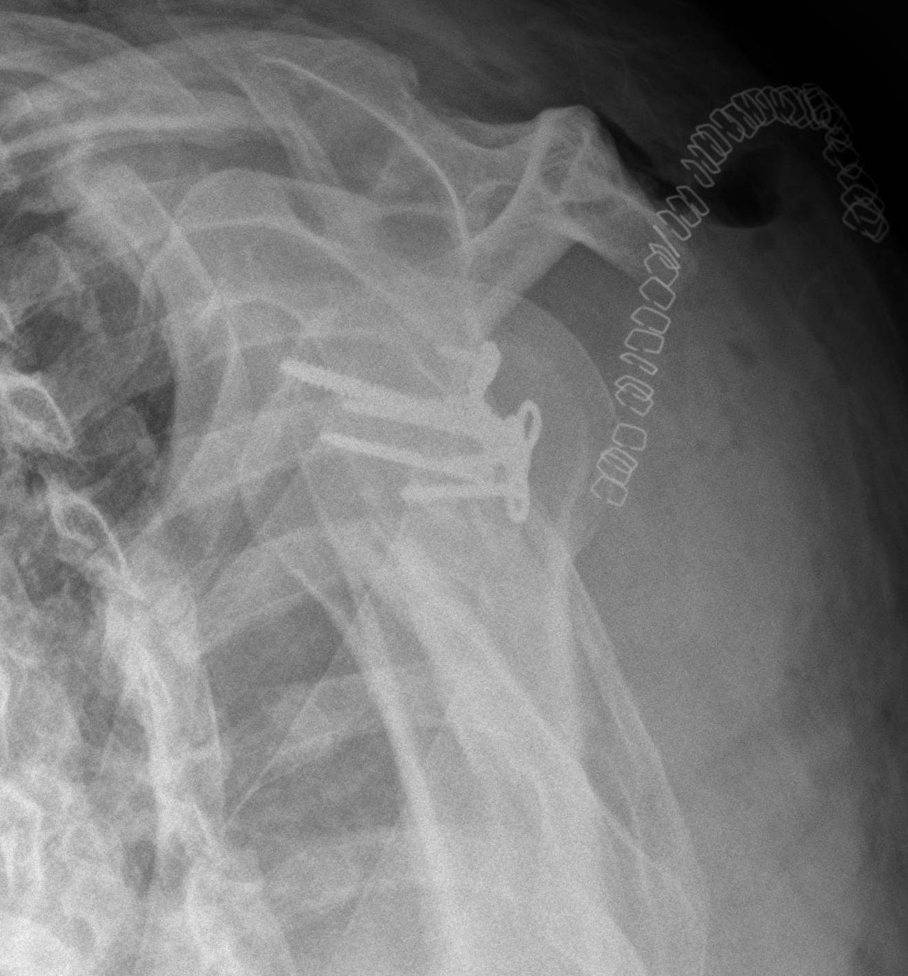Glenoid & Scapula Fractures The Bone School